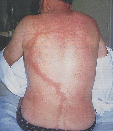 Human Lichtenberg Figure